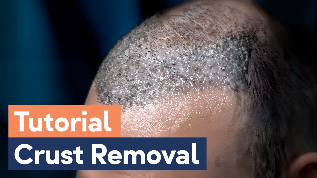 Removing Scabs After a Hair Transplant! | Guide