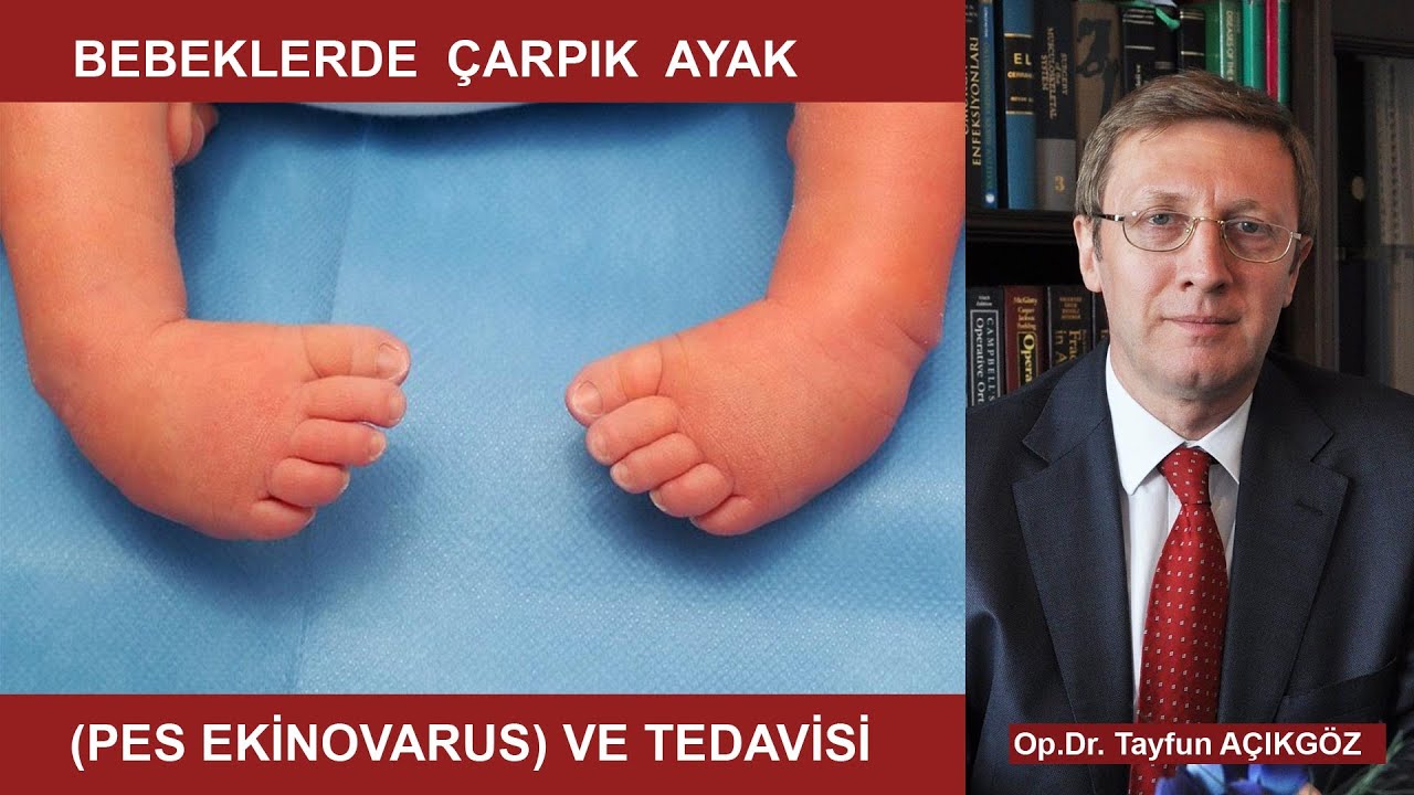 Doğuştan Çarpık Ayak (Pes Ekinovarus) Deformitesi ve Tedavisi
