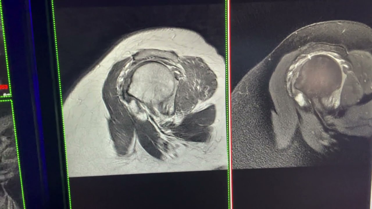 ISAKOS reporte resonancia magnética de hombro, lesiones del manguito rotador