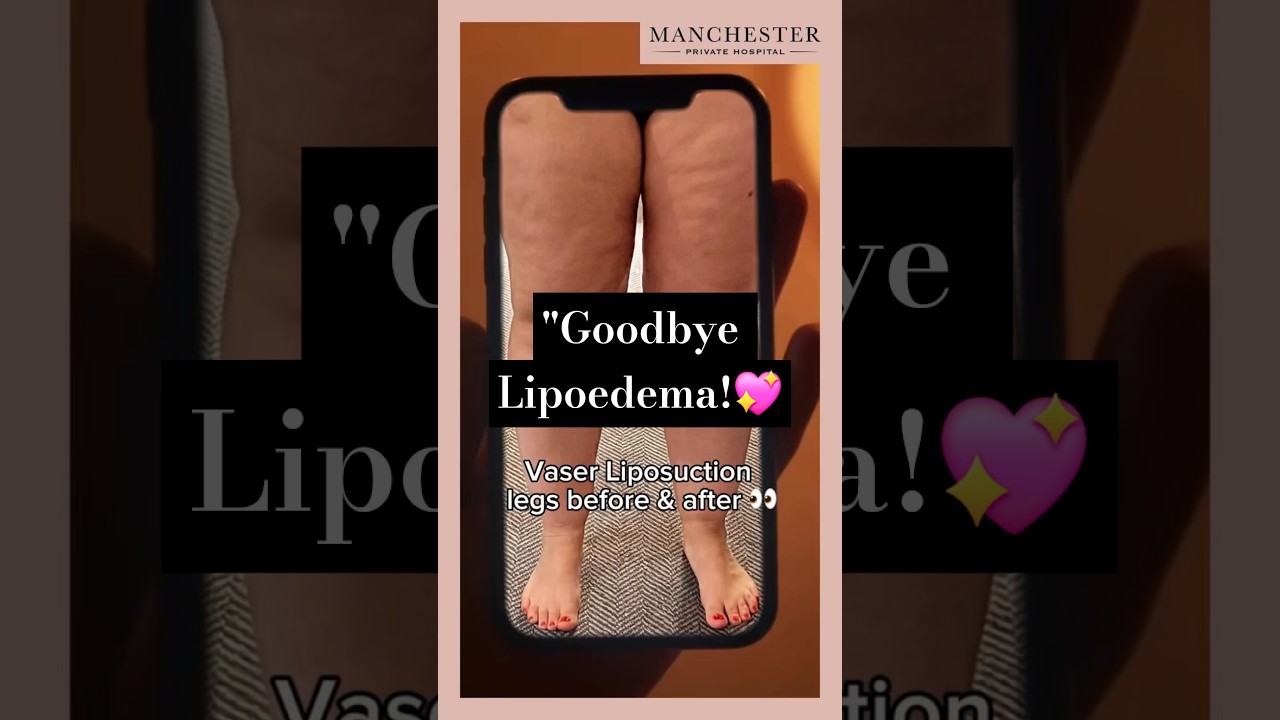 Vaser Liposuction for Lipoedema | Upper & Lower Leg Vaser Lipo Before and After Results