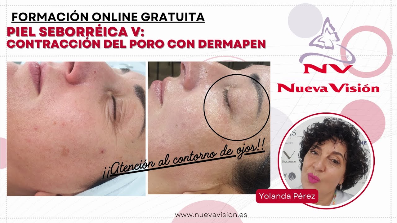 Contracción de poros con microneedling