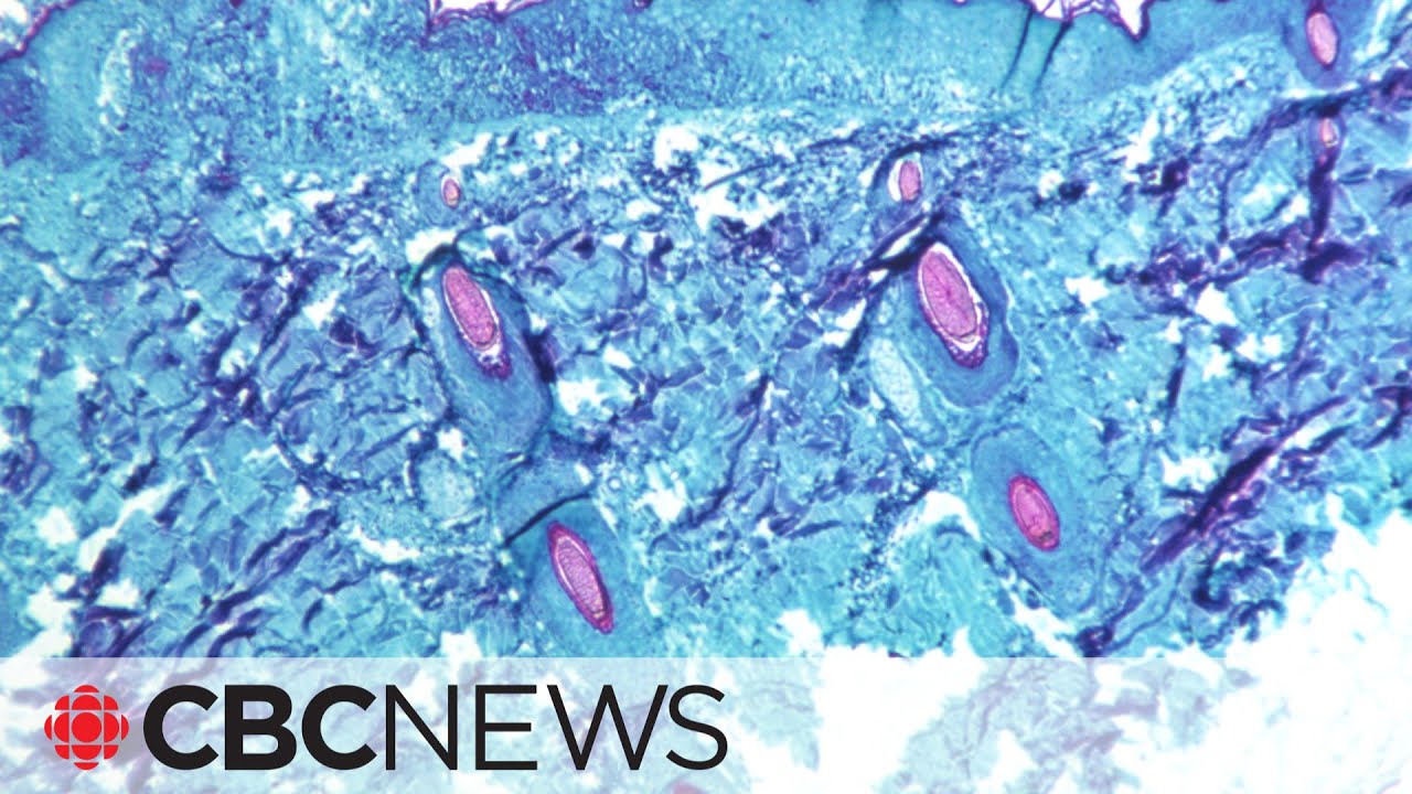 Monkeypox cases in Canada no reason for panic, says epidemiologist