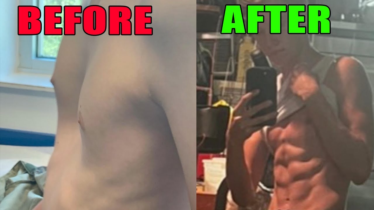 Working Out After The Nuss Procedure For Pectus Excavatum Correction
