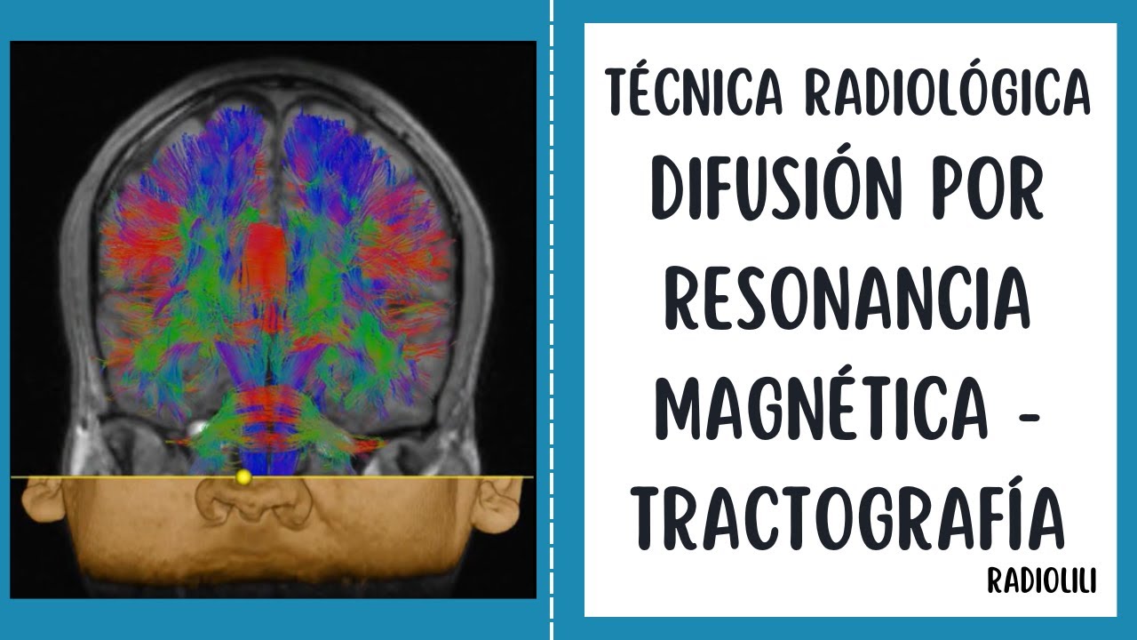 Difusi&oacute;n por resonancia magn&eacute;tica - Tractograf&iacute;a: T&eacute;cnica Radiol&oacute;gica.