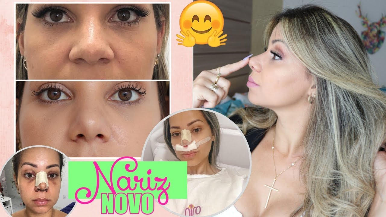 VLOG: MINHA RINOPLASTIA (DOR, RECUPERAÇÃO, VALORES...)