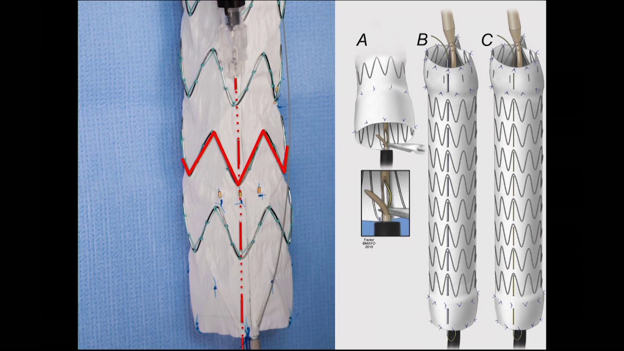 Dr. Gustavo Oderich - Physician Modified Fenestrated Endografts: Technical Aspects and Outcomes