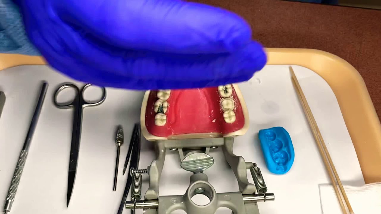 Временная (предварительная) коронка из одного блока с использованием VPS Putty и материала Turbo ...