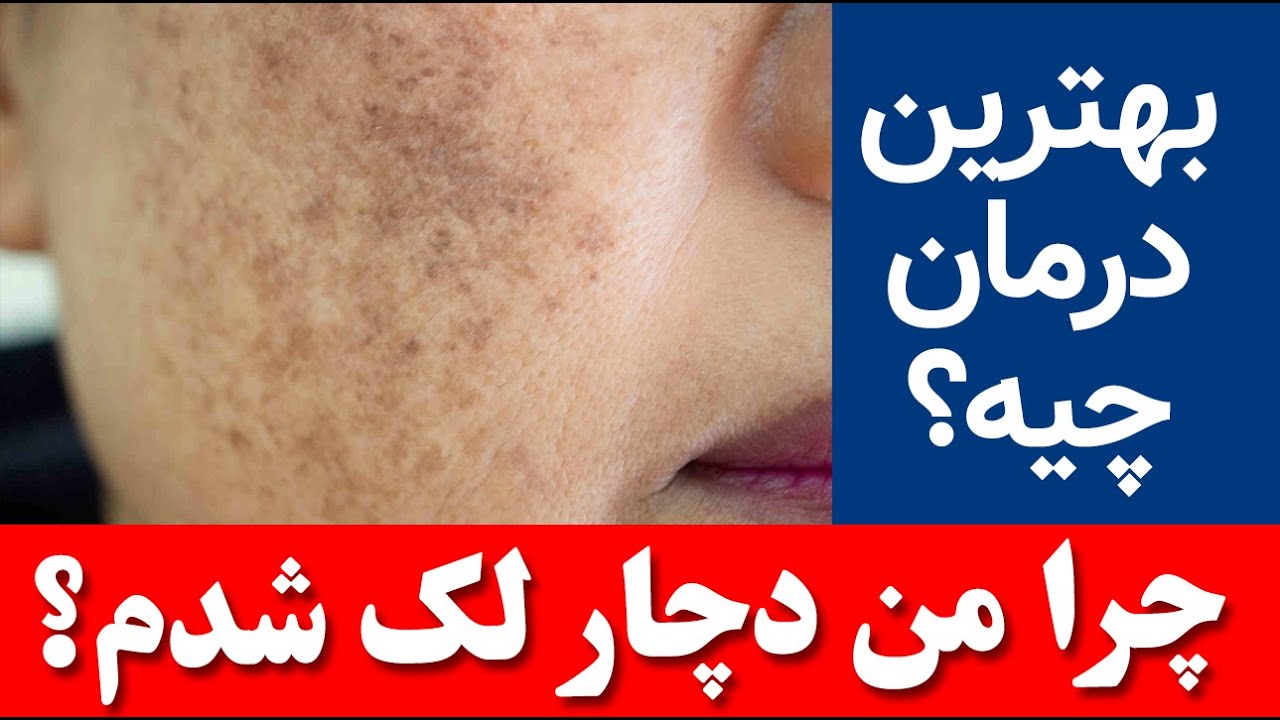 چرا دچار لک شدم؟ درمان لک چیه؟