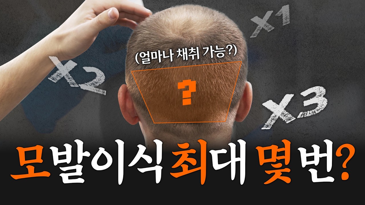 모발이식 다시 한다면 꼭 봐야 할 영상 | 모발이식 재수술