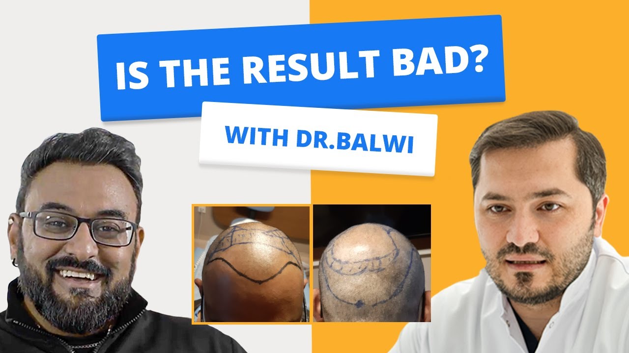 Hair Transplantation BEFORE AFTER I with Dr. Balwi