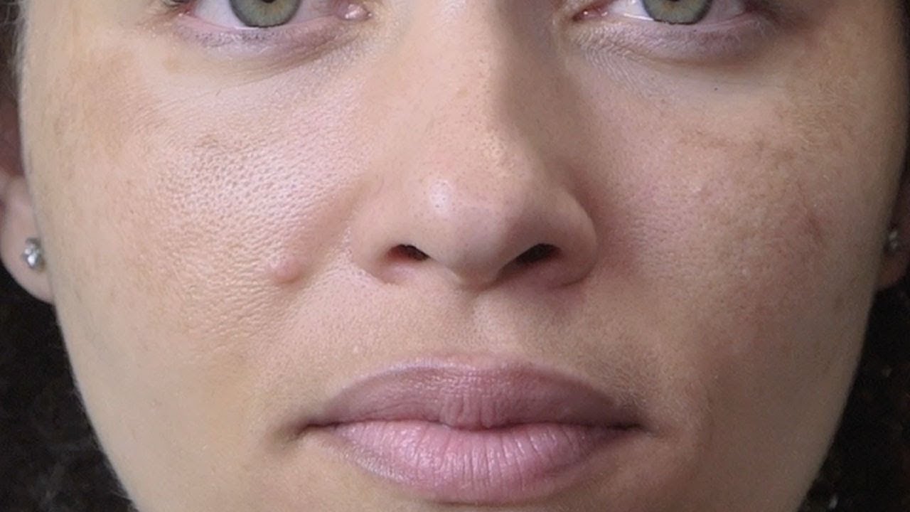 Azure's Melasma Progress