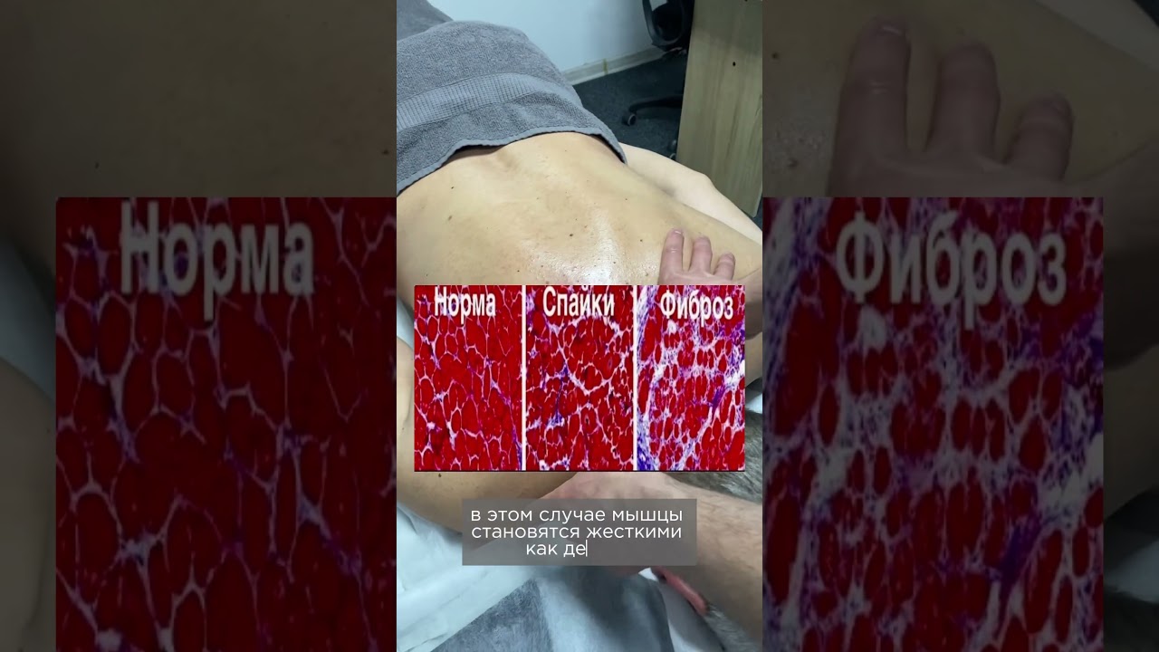 Миофиброз - дегенеративно- дистрофические изменения мышцы