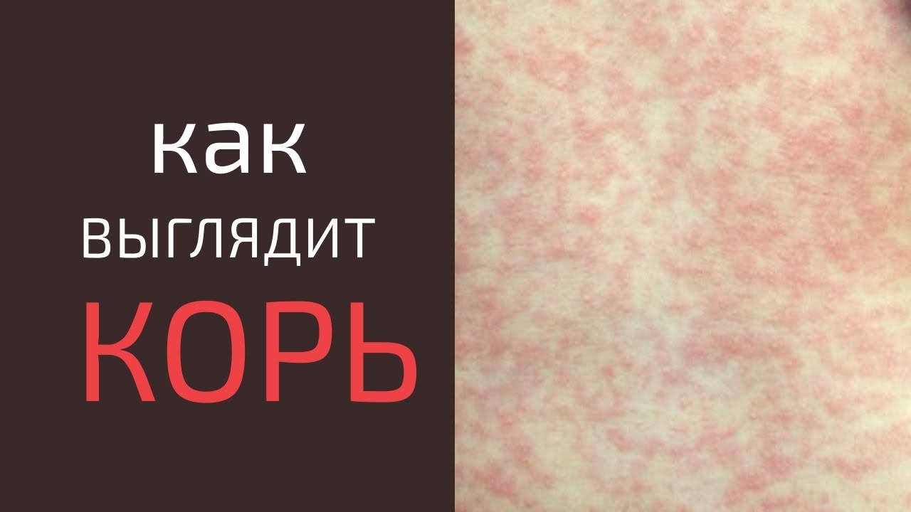 Как выглядит КОРЬ. Симптомы и протекание кори
