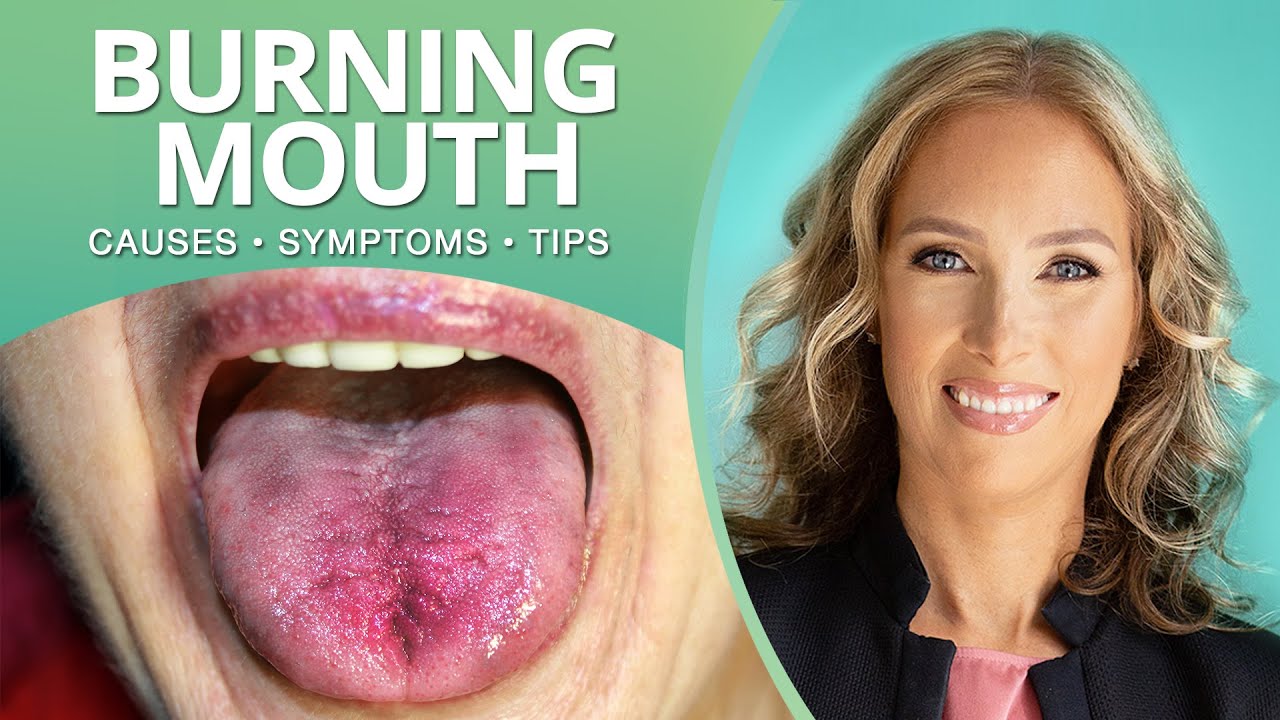 What Is Burning Mouth Syndrome, Causes, Symptoms & Tips | Dr. J9 Live