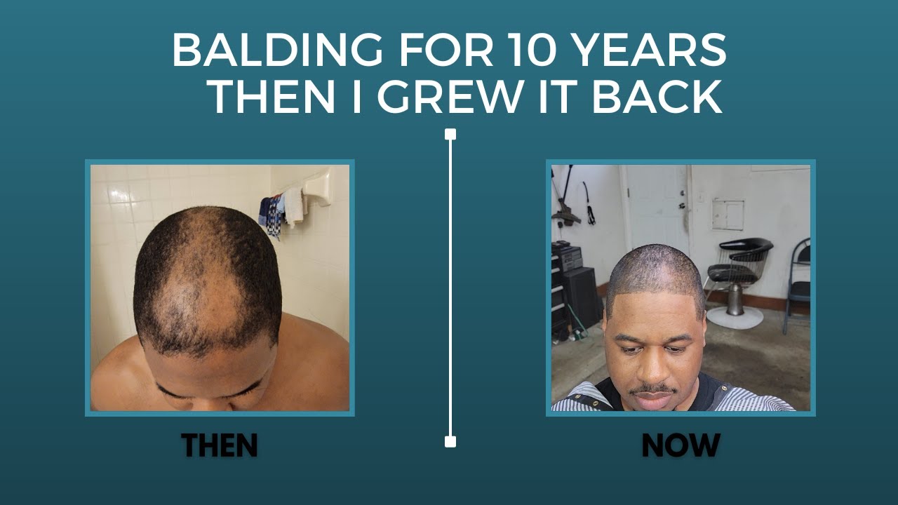 Hair Loss and Regrowth | How I Grew My Hair Back Without a Hair Transplant