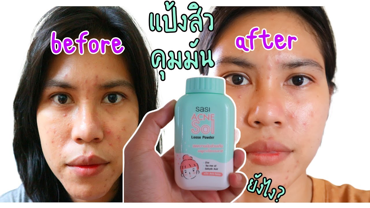 ลอง sasi acne loose powder แป้งสำหรับคนเป็นสิว ที่ช่วยควบคุมความมันด้วย! |Pla Kritsana