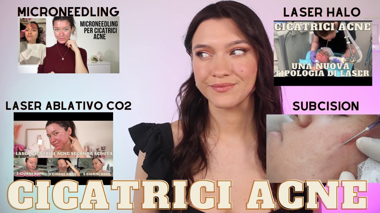 CICATRICI ACNE - TUTTI I TRATTAMENTI CHE HO FATTO-QUALI RIFAREI? QUALI NON FAREI? IL PIU EFFICACE ?