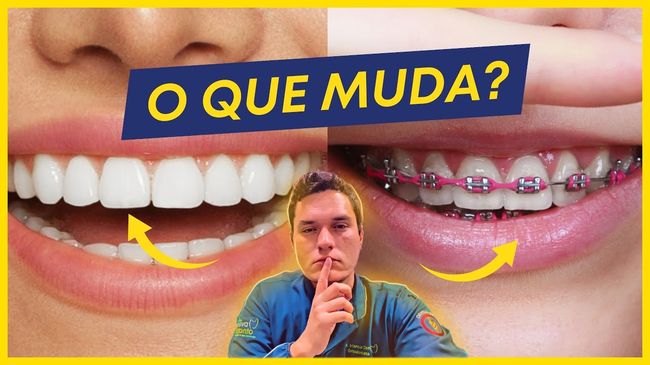 7 COISAS QUE MUDAM NA SUA VIDA APÓS COLOCAR APARELHO ORTODÔNTICO!