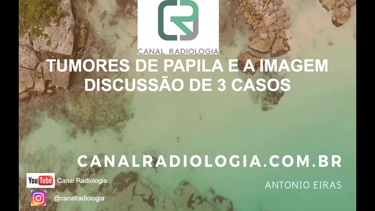 Tumores de Papila. Discussão de 3 casos e revisão do tema.
