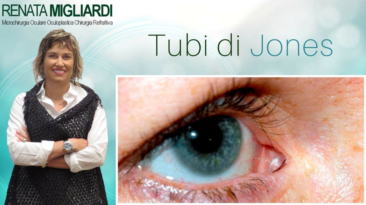 Tubi di Jones. Cura lacrimazione dell'occhio