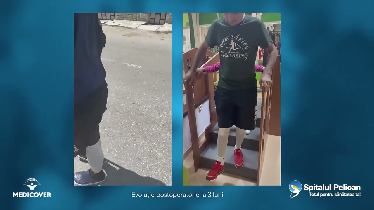 Spital Pelican: Dr Chirea - protezare segmentară a genunchiului după o fractură deschisă