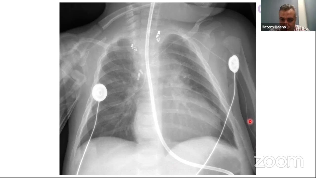 CHD@CEC, Webinar 11, Single Ventricle