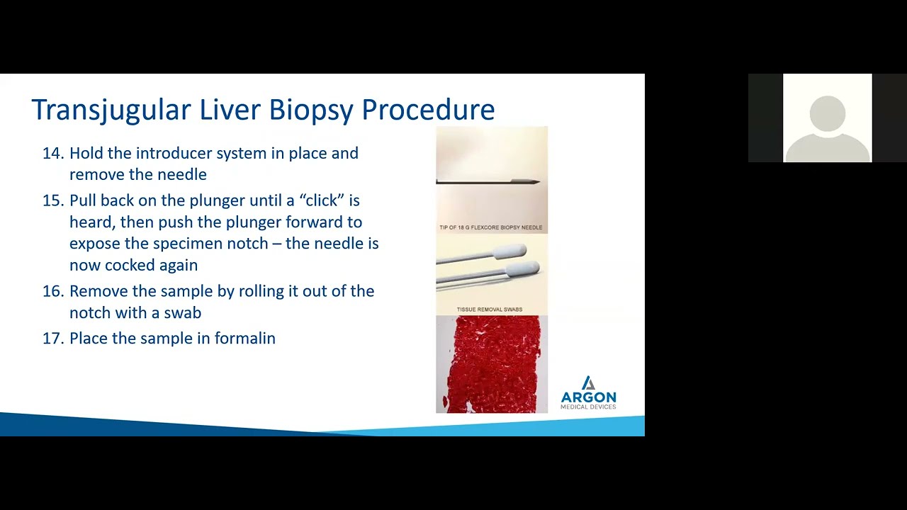 Transjugular Liver Biopsy Procedure and Argon Medical's TLAB Tricks & Tips
