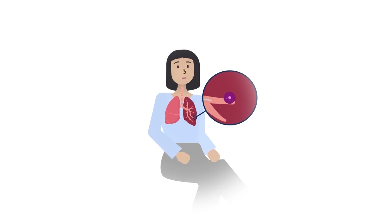 Explaining Robotic-Assisted Bronchoscopy