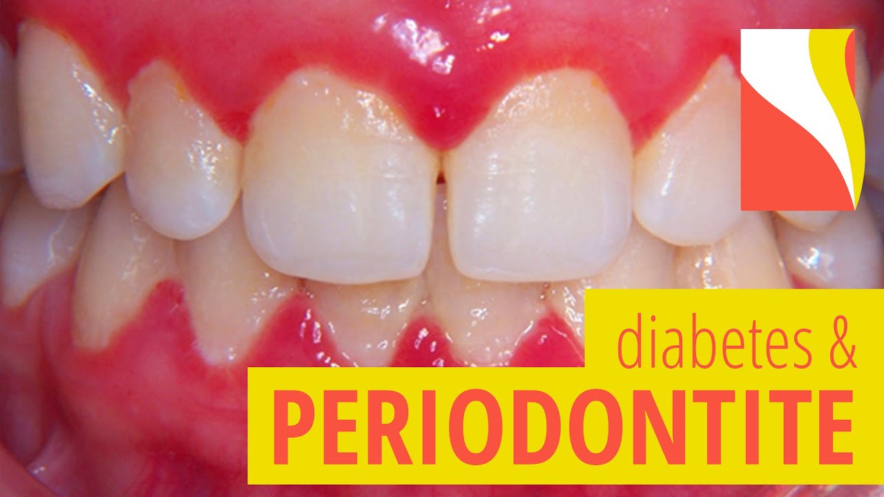Doença Periodontal e Diabetes - Riscos