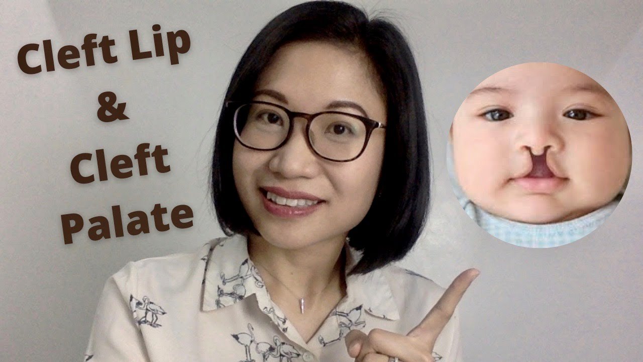 Cleft Lip and Cleft Palate: Causes, Complications, How is it Treated, Prevention | Dr. Kristine Kiat