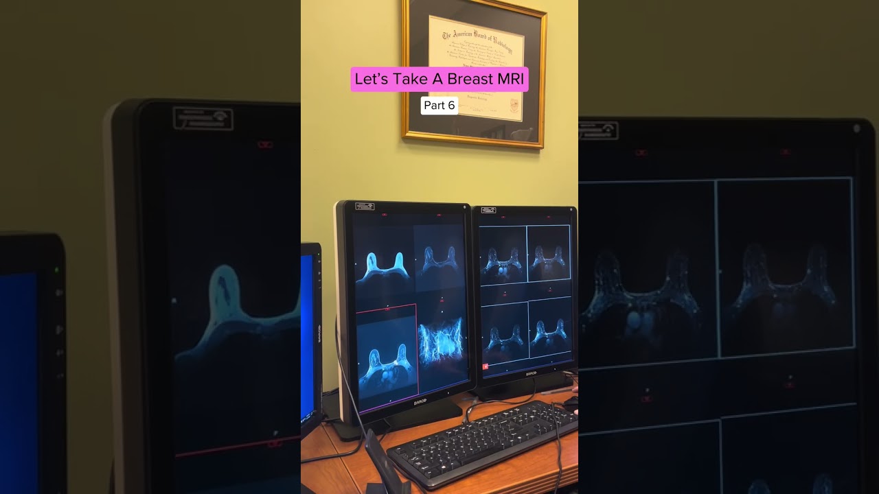 Breast scan MRI: Reading the results #shorts #breastcancer #breastmriscan