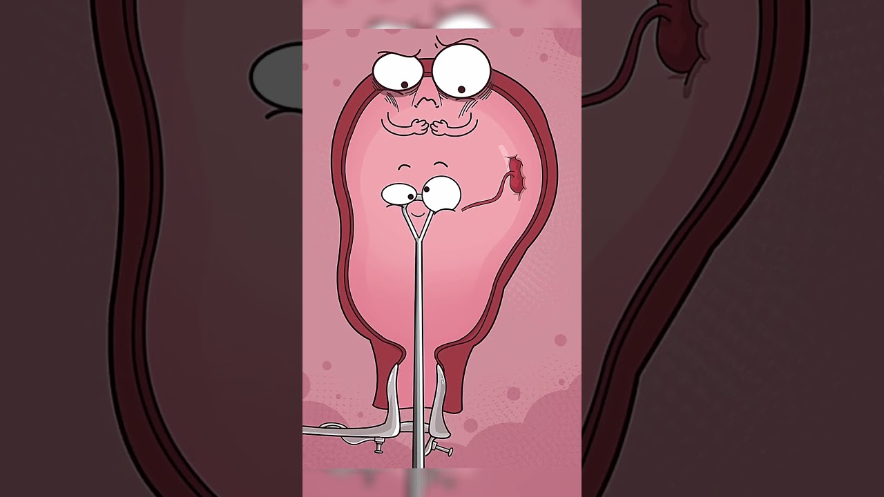 Ce qu'il se passe VRAIMENT lors d'un CURETAGE ! 😱🩸 (IVG)