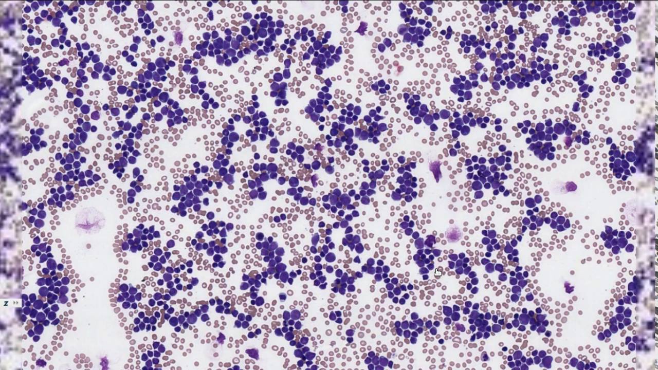 Hematoloji - Histopatoloji - KLL, AML, ALL
