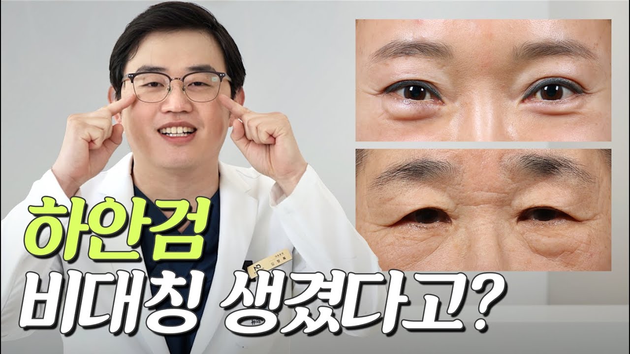 하안검 수술했더니 비대칭이 생겼어요 수술 부작용일까요?