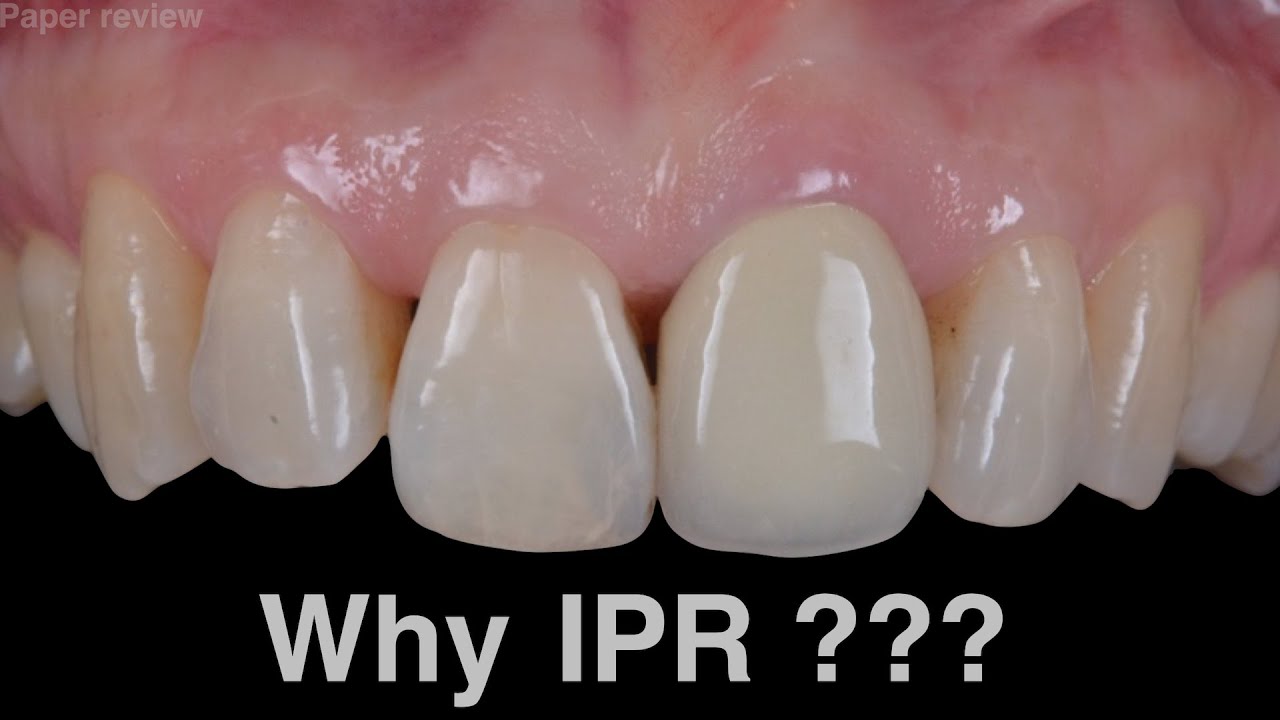 What should we know before IPR?｜【Chris Chang Ortho】CC682