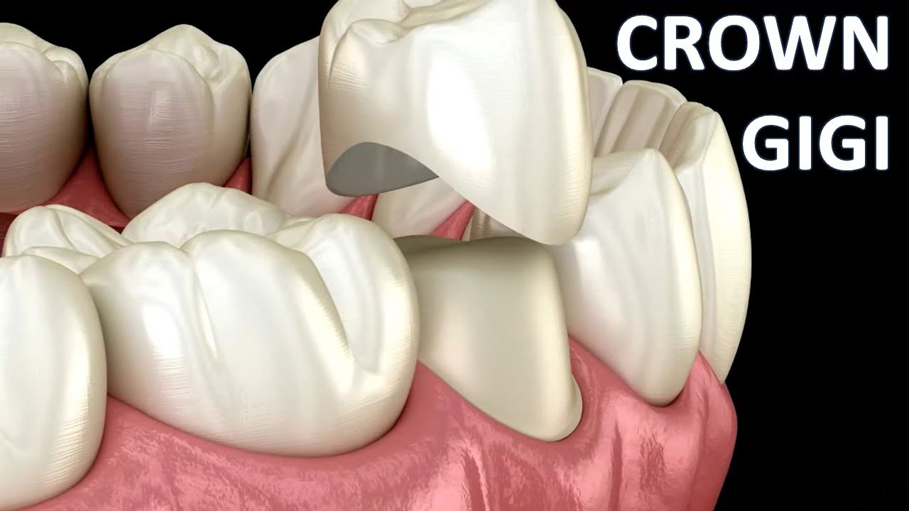 Proses pemasangan CROWN GIGI di dokter gigi