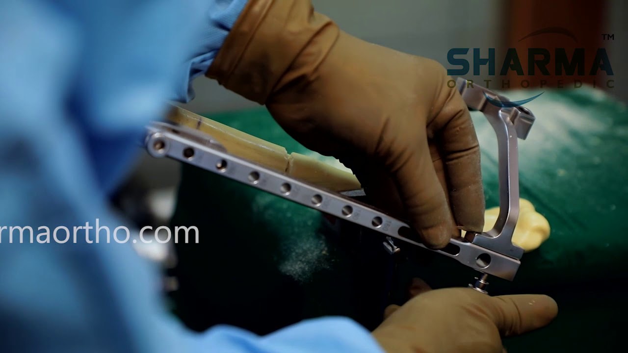 Humerus Nail/Expert Humeral Nail- compression