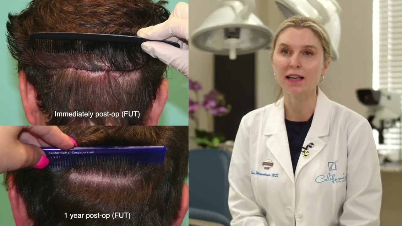 FUT or Strip Harvest Hair Transplant | When FUT is Effective