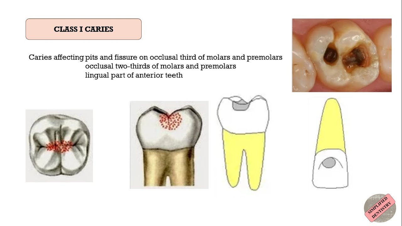 Quick Revision of G. V. Black's Classification of Dental Caries