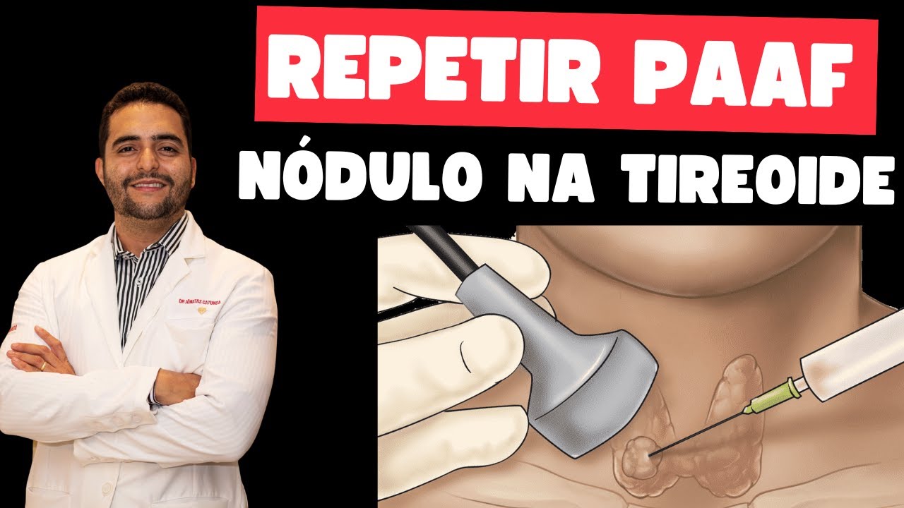 Quando precisa repetir a PAAF - punção aspirativa por agulha fina da tireoide