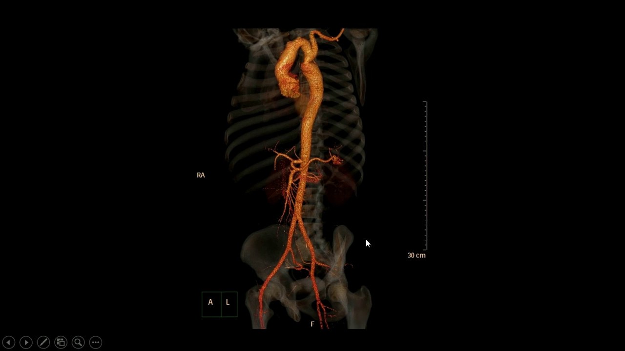 Coarctação da aorta