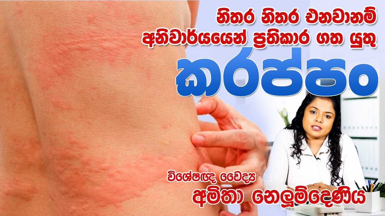 නිතර නිතර එනවානම් අනිවාර්යෙන් ප්‍රතිකාර ගත යුතු කරප්පං | Urticaria | Skin Specialist