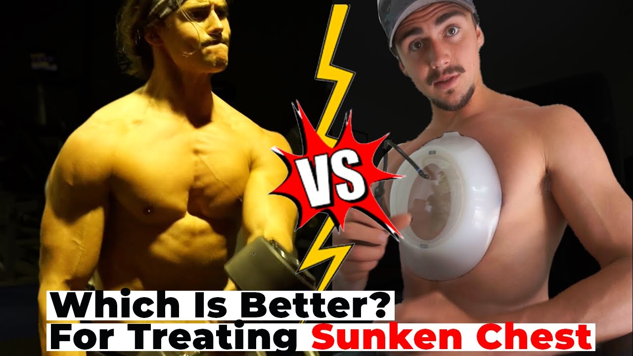 The Vacuum Bell OR Exercise to Fix Pectus Excavatum (What is better?)