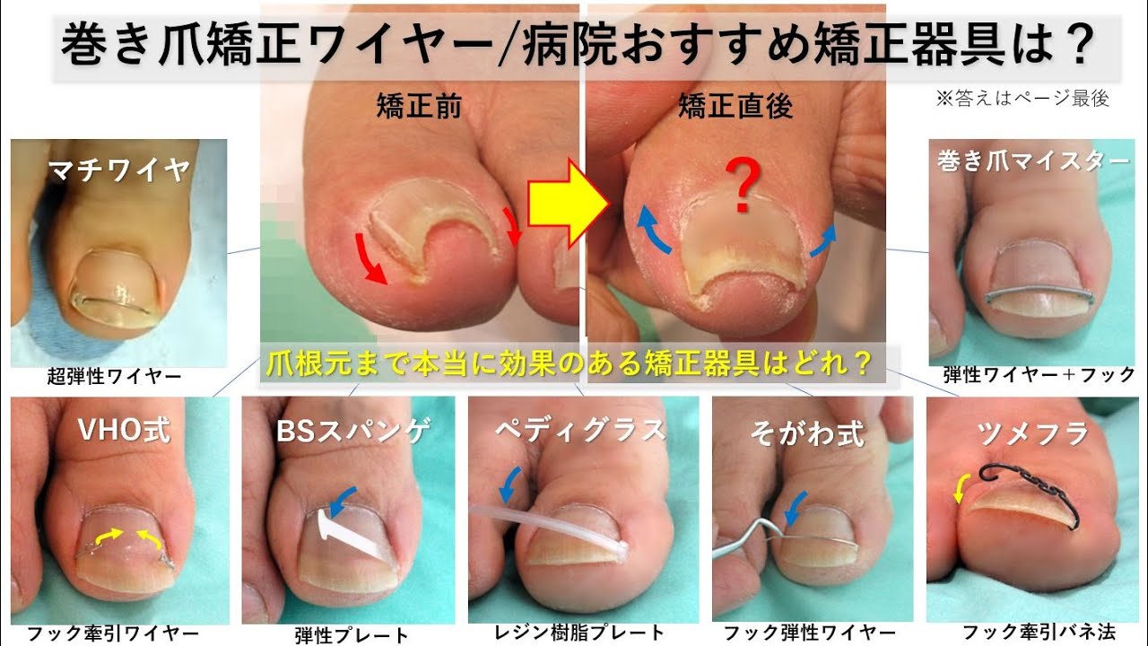 巻き爪矯正ワイヤー治療/病院おすすめ矯正器具の効果