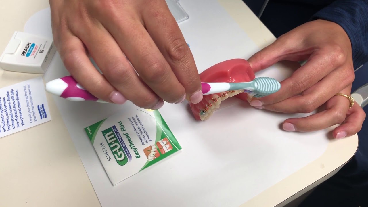 How to Take Care of Your Braces: Nirenblatt Orthodontics