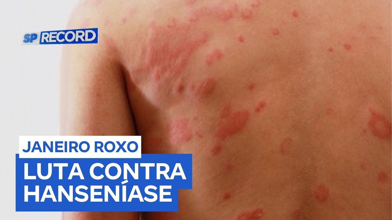 Brasil é o segundo país com mais casos de hanseníase no mundo