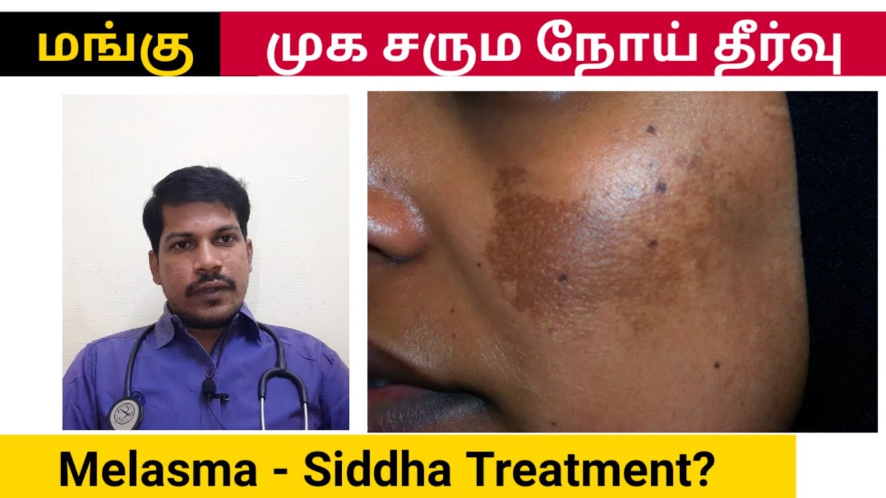 மங்கு- சரும நோய் தீர்வு | Melasma natural cure | Siddha Treatment 100% cure in 30days