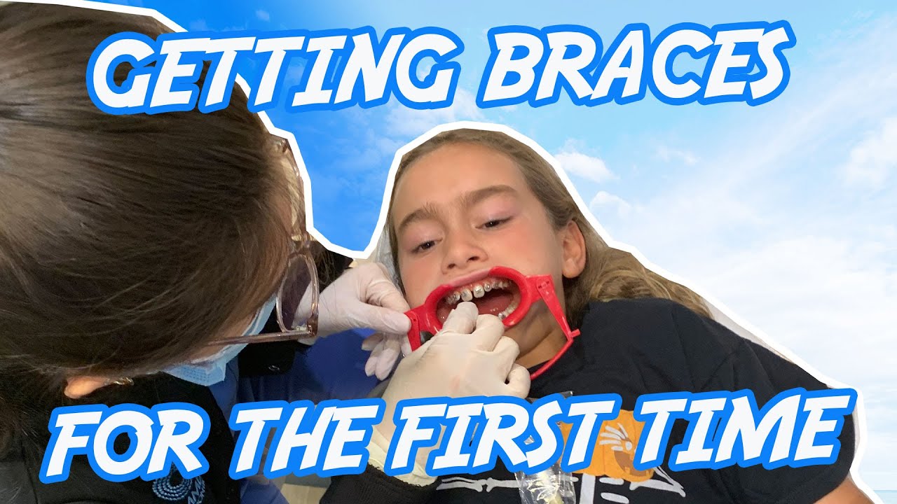 First Time Getting Braces | Getting Braces for the First Time