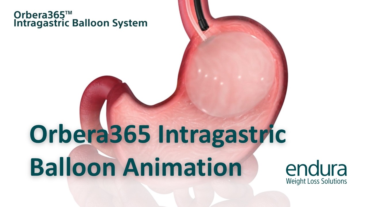 Orbera365™ Intragastric Balloon Animation | Boston Scientific