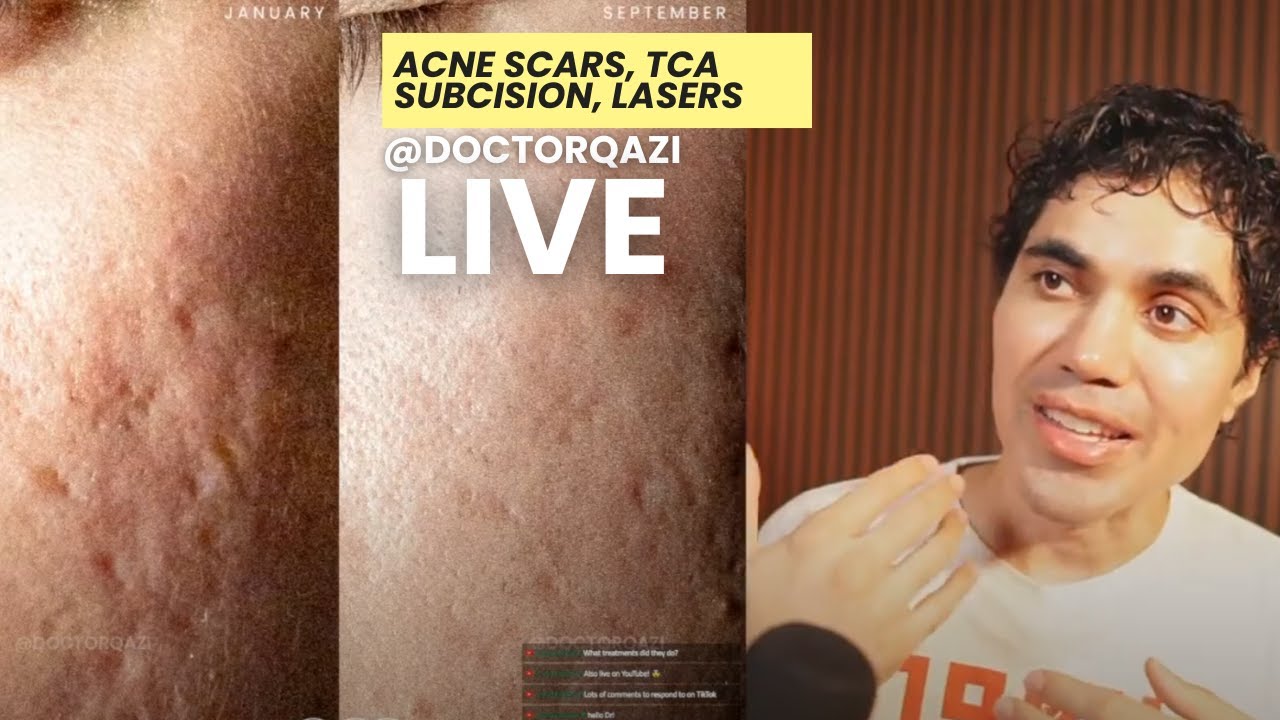 Dr. Qazi discusses Acne Scars, Subcision, TCA Cross, Lasers | Dr. Qazi Unsponsored Live | 9.11.2024